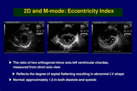 lv eccentricity index|eccentricity index echocardiogram.